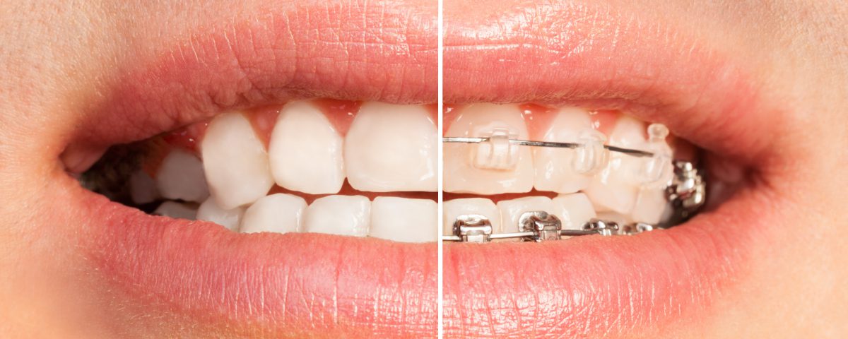 traditional braceds - Stevenson Family Dentistry -